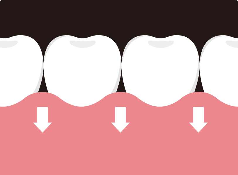 歯ぐき下りによる「はさまりスポット」ができる様子のイメージ動画